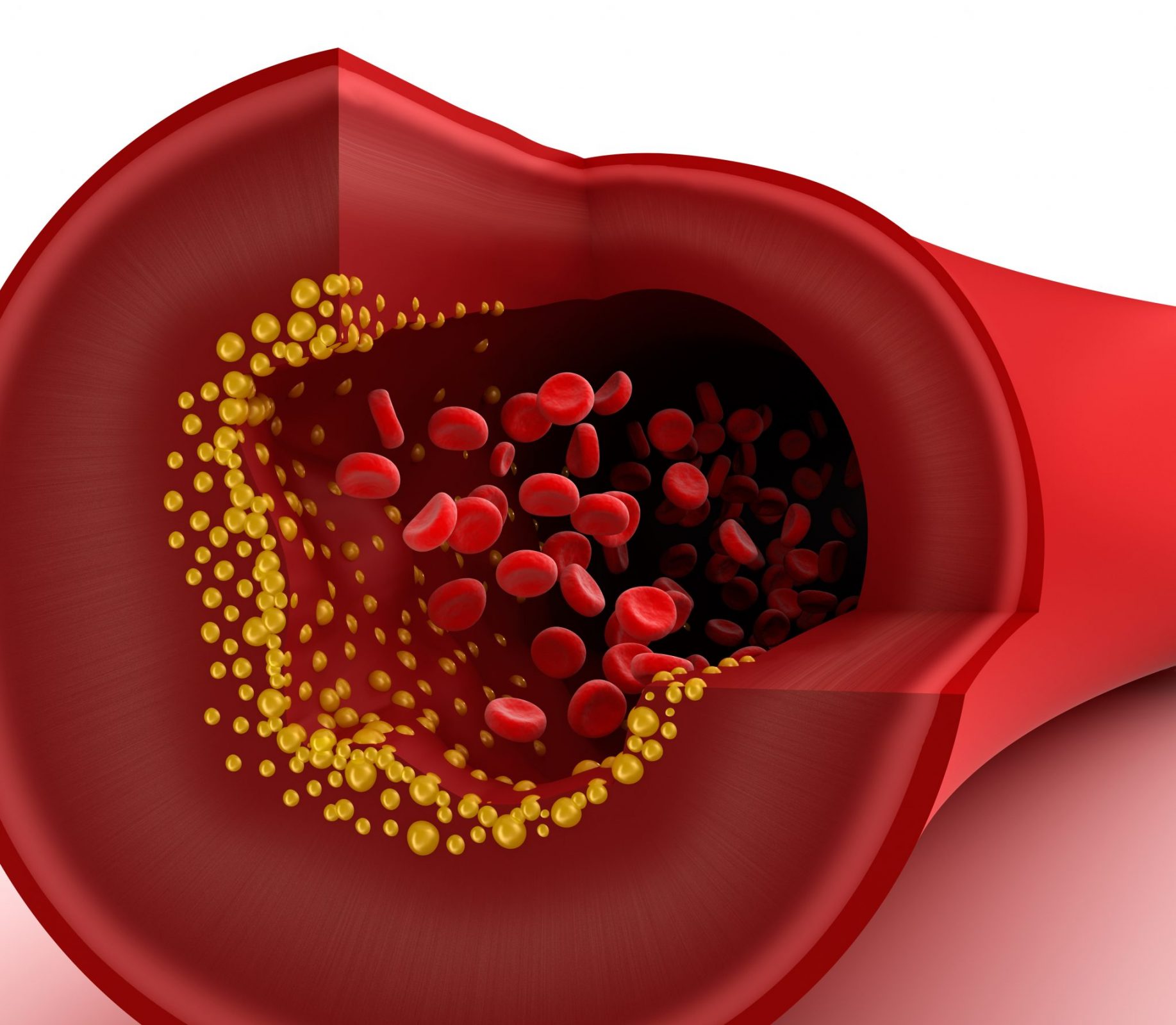 coronary-artery-disease-ischemic-heart-disease-overview-coronary