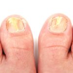 toe-fungus