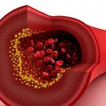 Reversing ischemic heart disease naturally