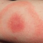 Lyme disease myths and facts revealed | NaturalHealth365