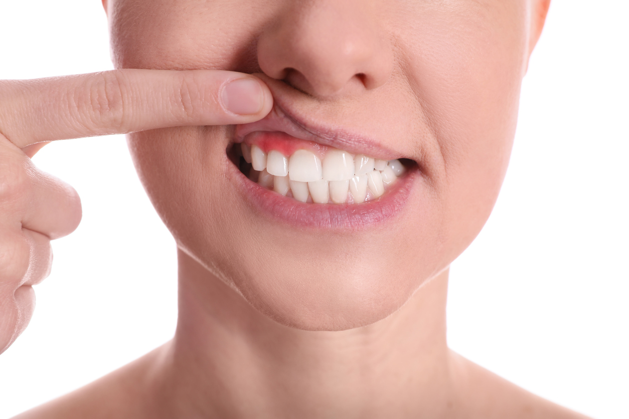 gum-disease-linked-to-cancer-naturalhealth365